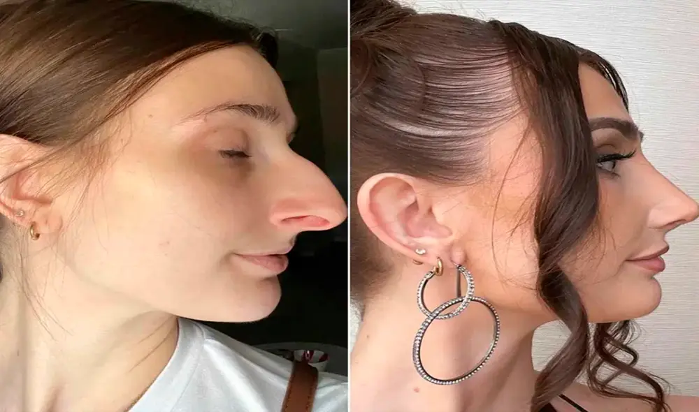 El inesperado giro en la vida de una joven tras una rinoplastia de 11.000 dólares. Foto:New York Post El inesperado giro en la vida de una joven tras una rinoplastia de 11.000 dólares. Foto:New York Post
