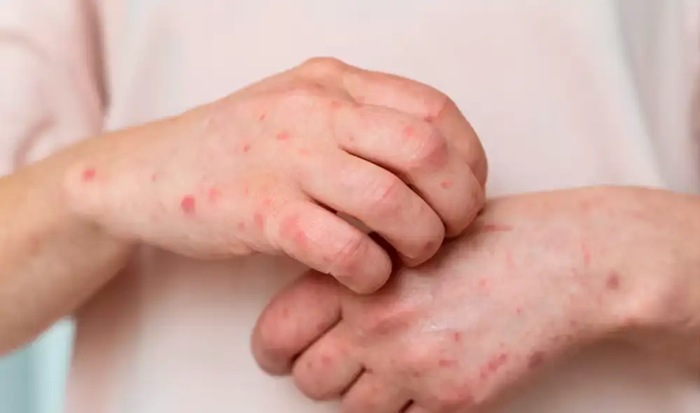 El primer caso de sarampión en Nueva Jersey en 2025 fue reportado el 19 de marzo. Foto: difusión