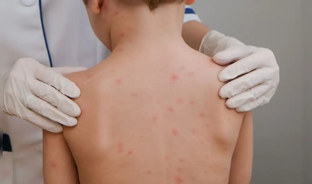 El brote de sarampión en Texas continúa cobrando víctimas, mientras crece el llamado a la vacunación en EE.UU. Foto: Consultorsalud El brote de sarampión en Texas continúa cobrando víctimas, mientras crece el llamado a la vacunación en EE.UU. Foto: Consultorsalud