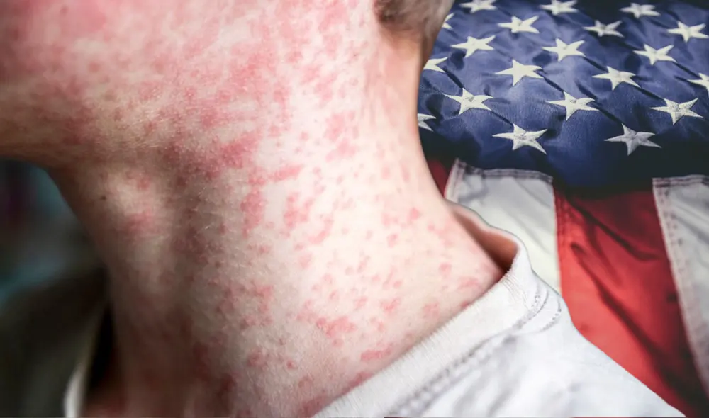 Con más de 600 casos de sarampión en EE.UU., la vacuna MMR es clave para prevenir brotes y proteger la salud pública. Foto: composición LR/CNN Con más de 600 casos de sarampión en EE.UU., la vacuna MMR es clave para prevenir brotes y proteger la salud pública. Foto: composición LR/CNN