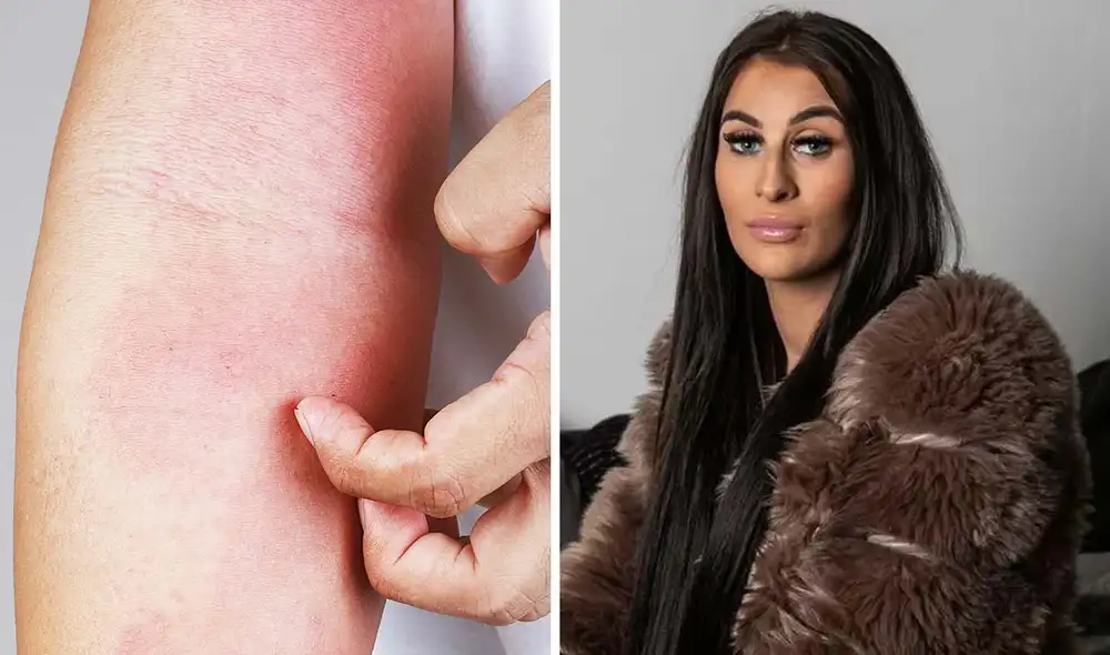 Kendall Bryce, madre del Reino Unido con urticaria acuagénica, describe el dolor extremo que sufre al entrar en contacto con el agua. Foto: composición LR/SWNS