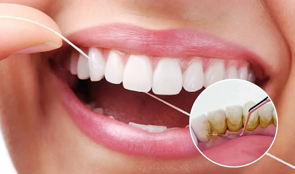 El sarro dental es una acumulación de placa endurecida que afecta la salud bucal y puede provocar problemas como caries, enfermedades en las encías y pérdida de dientes. Foto: composición LR