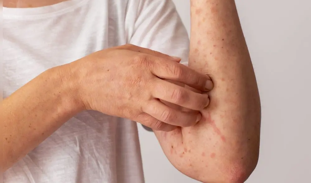 Estados Unidos ha reportado más de 800 casos en 2025. Otros estados, como Indiana y Michigan, también enfrentan brotes vinculados al resurgimiento en Texas. Foto: Freepik