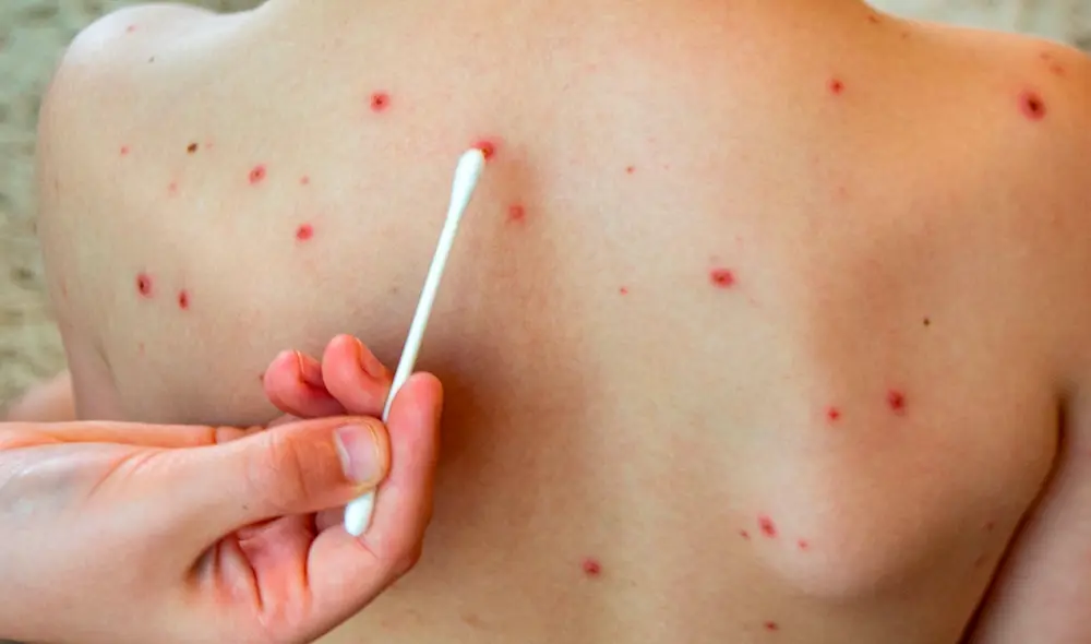 Las cifras de la enfermedad y los recientes fallecimientos, dejan entrever la baja cifra de vacunación en el país. Foto: Aula de la farmacia