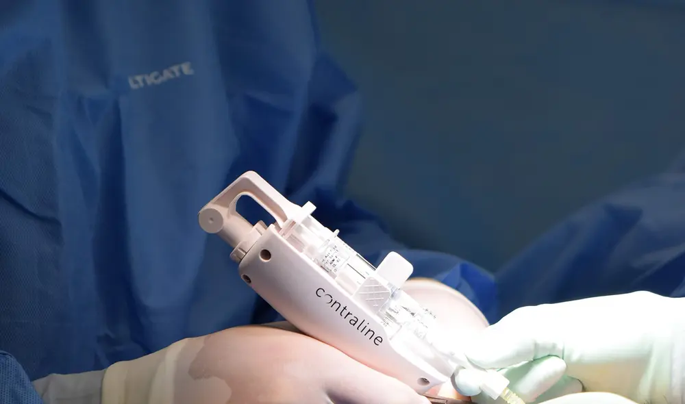 El implante se insertó mediante un procedimiento mínimamente invasivo que duró unos 10 minutos y utilizó anestesia local. Foto: Contraline