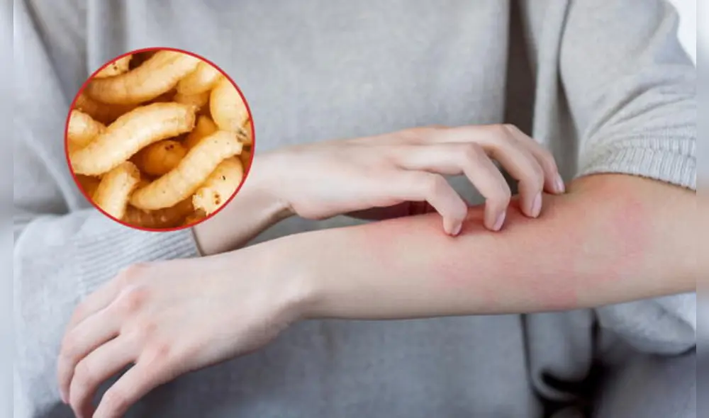 México confirma un nuevo caso humano de miasis por gusano barrenador en Chiapas. México confirma un nuevo caso humano de miasis por gusano barrenador en Chiapas.