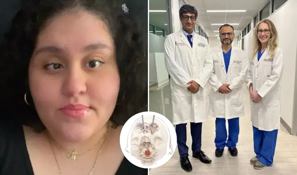 Cirujanos accedieron por el ojo y el pómulo de Karla Flores, para retirar el tumor espinal.