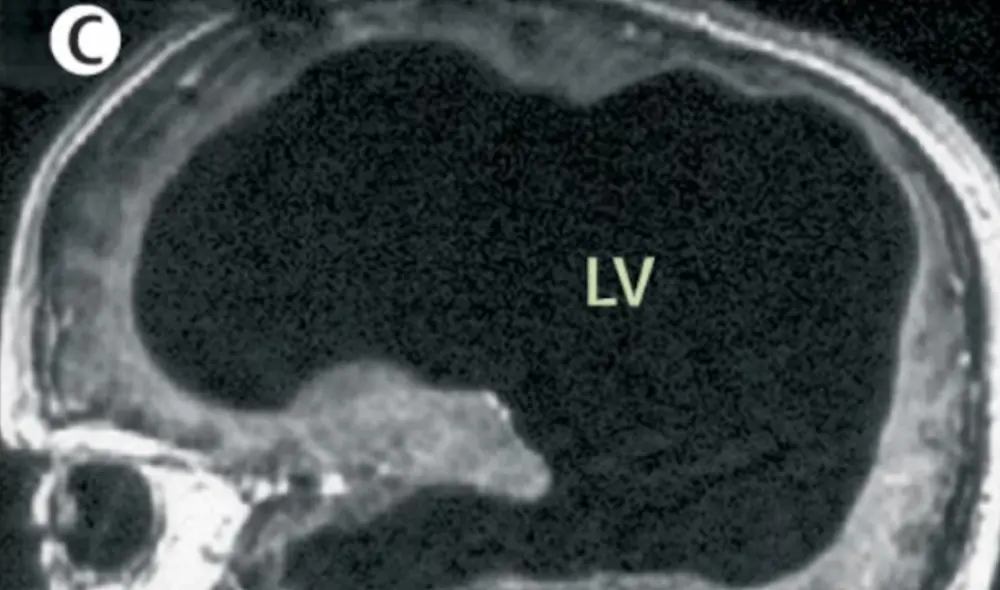 Diagnosticado desde la infancia, el paciente ha mantenido su independencia y una vida normal, a pesar de su condición neurológica extrema. Foto: The Lancet