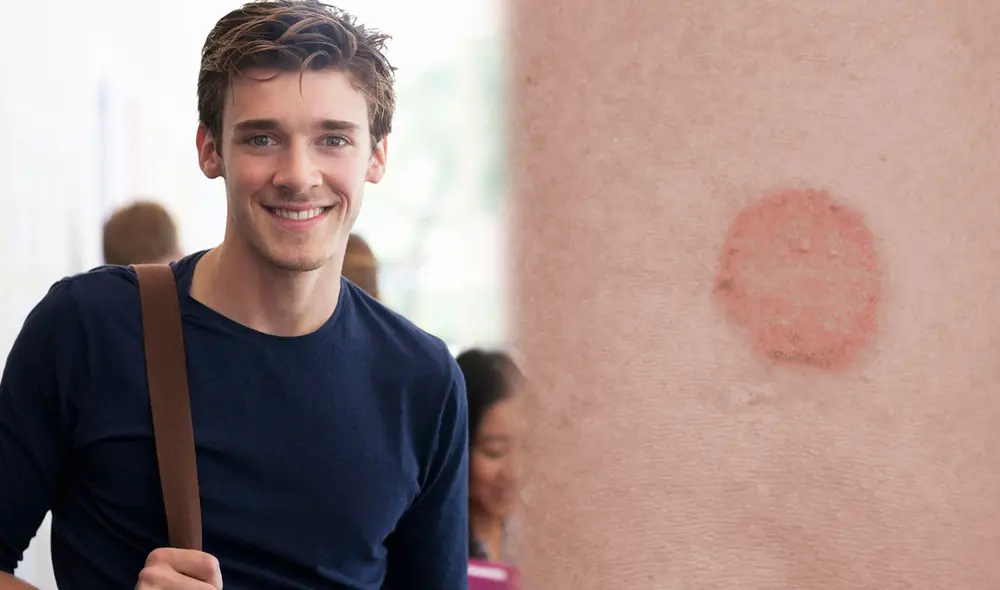 Estudiante sufre extraña mancha en su piel y asiste al médico tras consultar en Reddit.