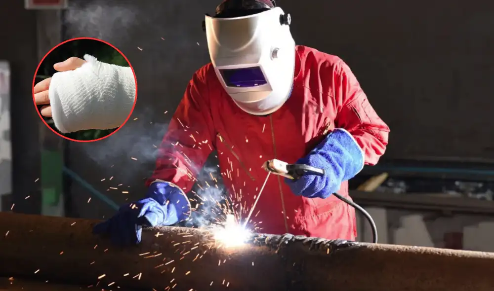 Soldador se fractura la mano trabajando en EEUU. Soldador se fractura la mano trabajando en EEUU.