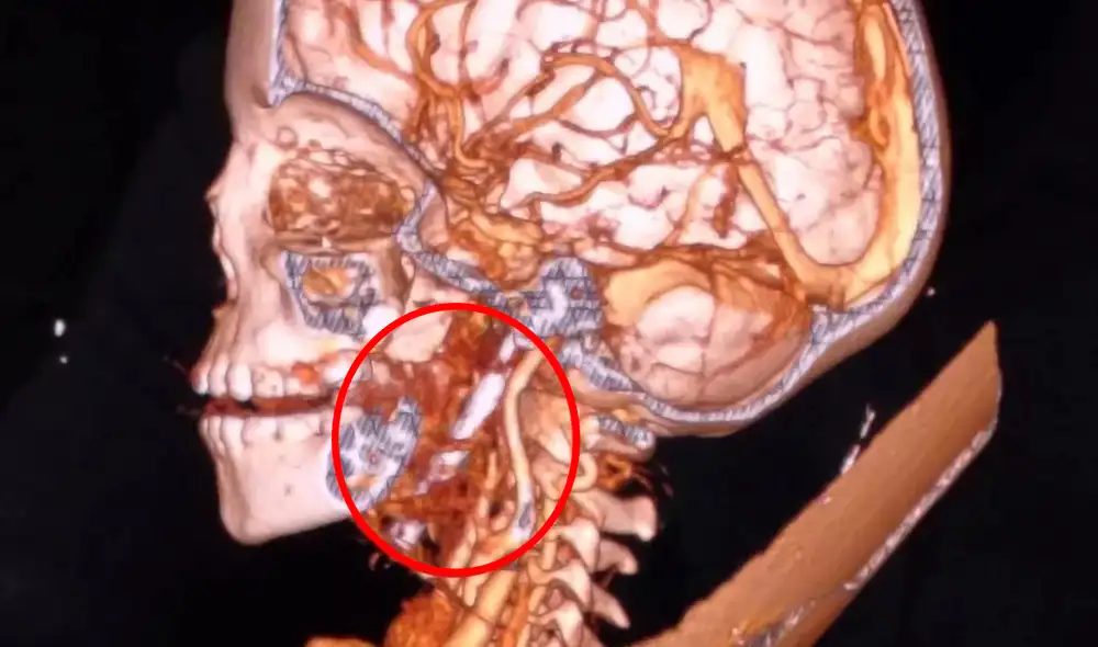 Las resonancias magnéticas y las tomografías mostraron el clavo de 8 cm que tenia el menor en su cerebro en la India. Foto: The Mirror