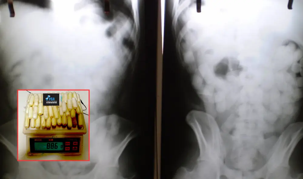 Este caso resalta los riesgos extremos que algunos individuos asumen al participar en el tráfico internacional de drogas. Foto: composición LR/Clarín/Policía de Seguridad Aeroportuaria Este caso resalta los riesgos extremos que algunos individuos asumen al participar en el tráfico internacional de drogas. Foto: composición LR/Clarín/Policía de Seguridad Aeroportuaria