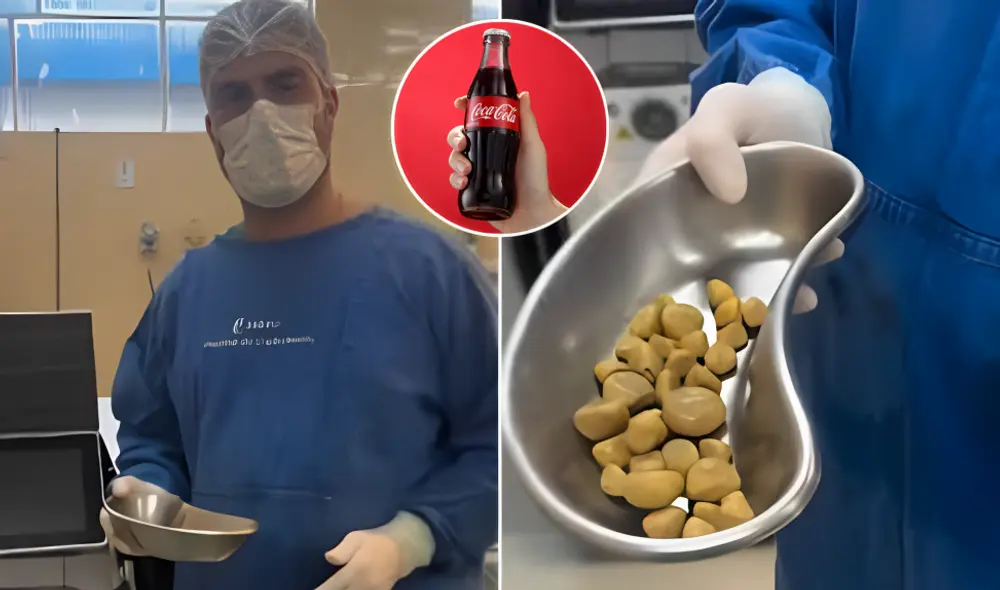 Plato con 35 cálculos extraídos tras años de consumo excesivo de gaseosas. Foto: @aapayes Plato con 35 cálculos extraídos tras años de consumo excesivo de gaseosas. Foto: @aapayes