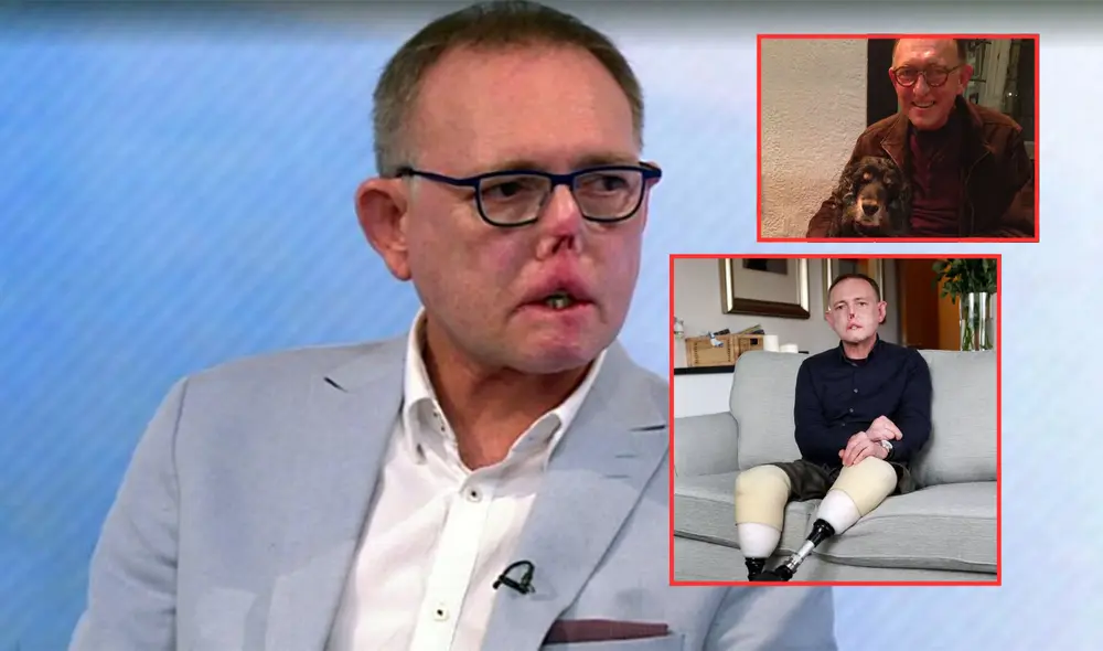 Jaco Nel sufrió la pérdida de sus piernas, dedos de una mano y parte de su rostro tras el arañazo y lamida de su perro Harvey. Foto: Composición LR/ BBC/ Instagram de Jaco Nel/ Cambridge News