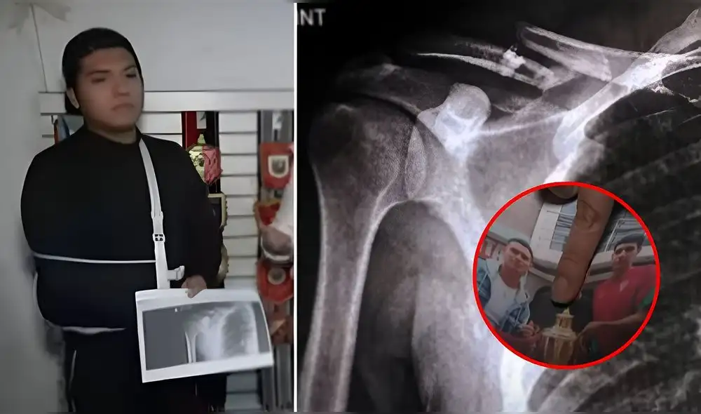 Renzo Santos fue agredido por tres individuos, quienes le rompieron la clavícula. Foto: Composición LR