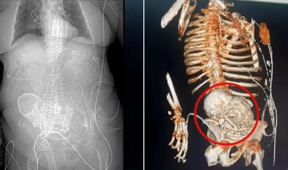 Mujer evitó controles médicos por décadas; hallaron un feto calcificado. Foto: X/@AlertaMundoNews