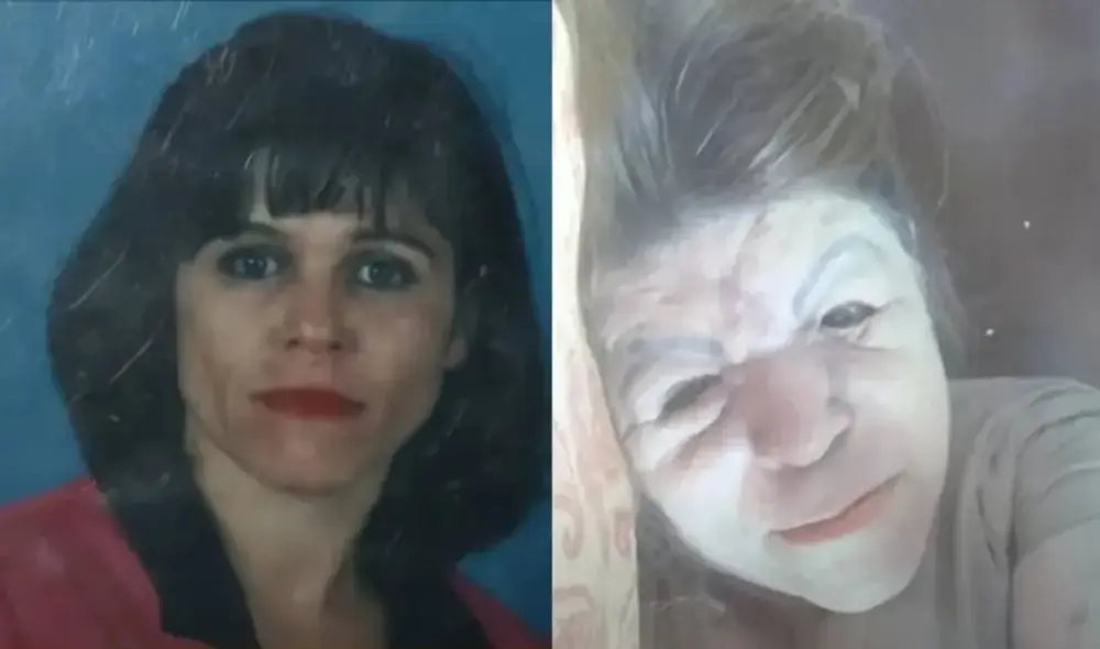 En Colombia, el uso de biopolímeros en procedimientos estéticos ha dejado un rastro de dolor y sufrimiento. Foto: noticias caracol