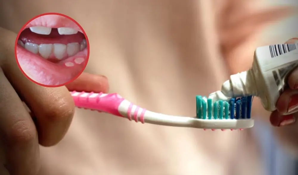 ¿Qué causa el fluoruro de estaño? El compuesto presente en 14 pastas dentales en Perú que el Digemind alertó como riesgoso