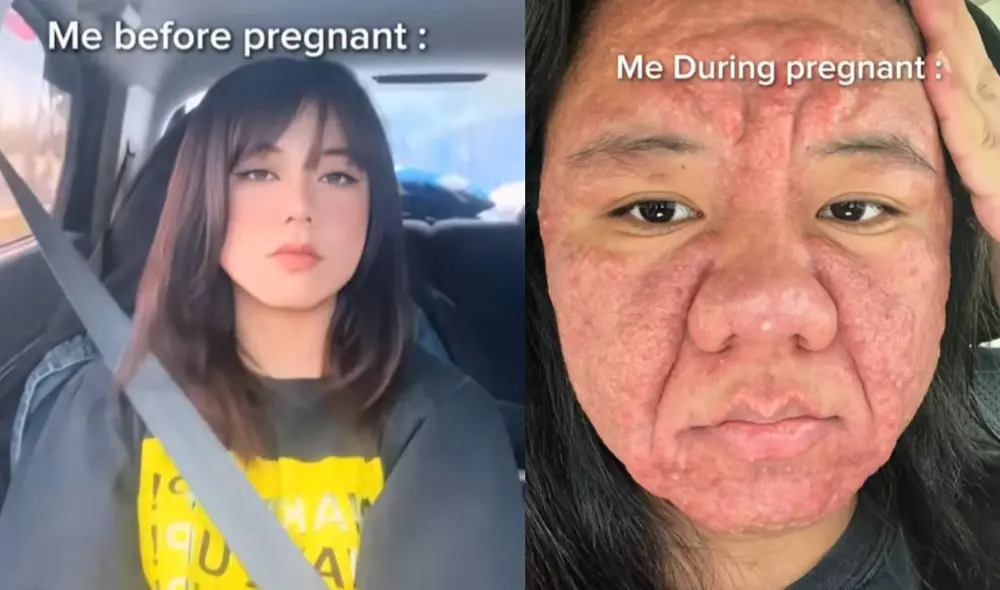 La joven de 28 años sufrió acné gestacional, por lo que, su rostro cambio bastante.