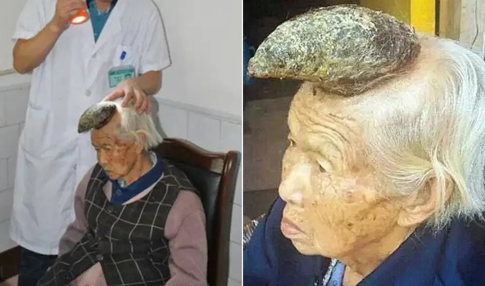 Liang Xiuzhen sufrió un raro cuerno cutáneo y usó hierbas antes del diagnóstico. Foto: ABC / Minuto Uno