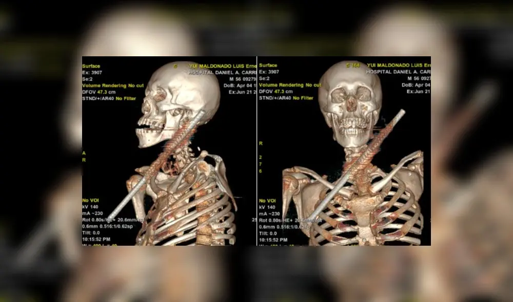 Médicos del hospital Carrión extrajeron fierro a paciente