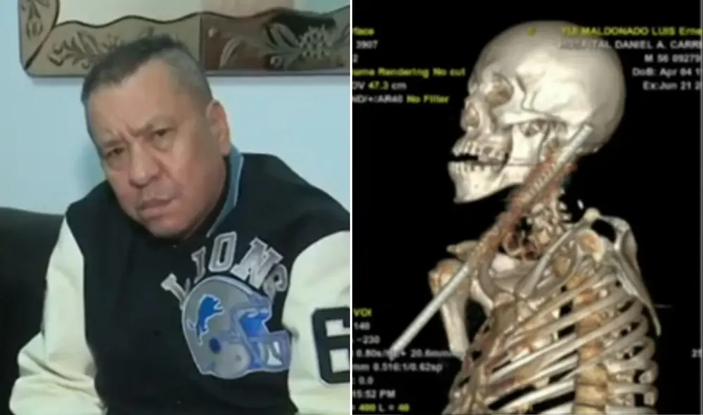 Hombre sobrevive milagrosamente tras caer sobre una reja de fierro en Magdalena del Mar