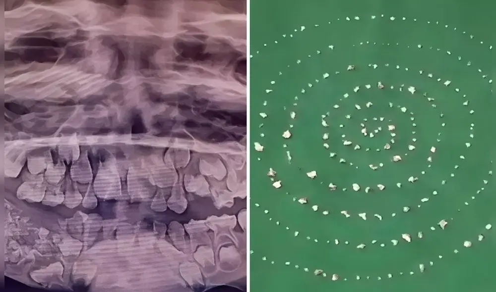 Un niño en India sorprendió al mundo tras serle extraídos 526 dientes, estableciendo un nuevo récord mundial en odontología