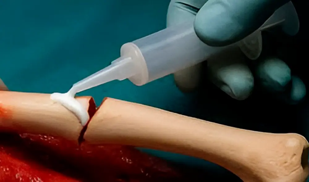 Científicos chinos crearon el Bone 02, un innovador gel o "pegamento óseo".