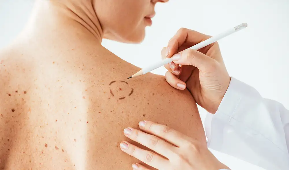 El melanoma representa aproximadamente el 5% de los cánceres de piel y puede ser muy agresivo. Foto: Quironsalud El melanoma representa aproximadamente el 5% de los cánceres de piel y puede ser muy agresivo. Foto: Quironsalud