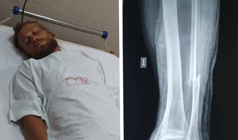 El turista ruso estuvo internado en el hospital de Áncash tras ser atropellado. El turista ruso estuvo internado en el hospital de Áncash tras ser atropellado.