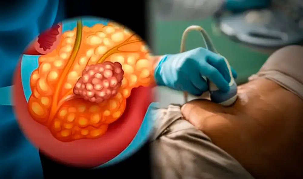 España avanza en la lucha contra el cáncer de pancreas.