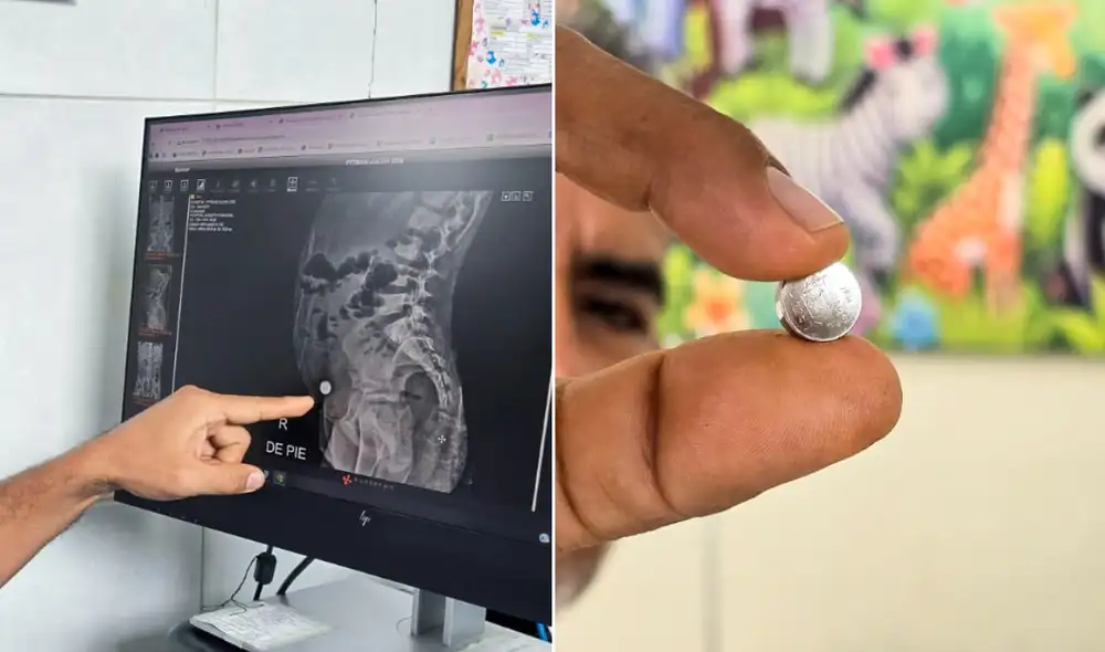 Menor de 6 años se salva tras extraer pila de reloj de su intestino Menor de 6 años se salva tras extraer pila de reloj de su intestino