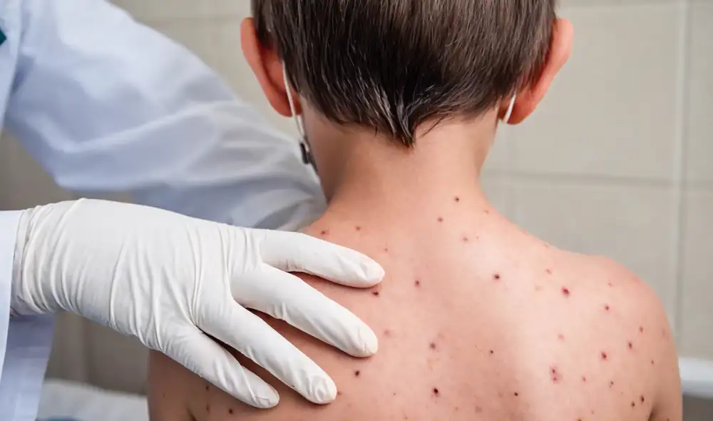 Los pacientes detectados con el mal ya son atendidos por especialistas.