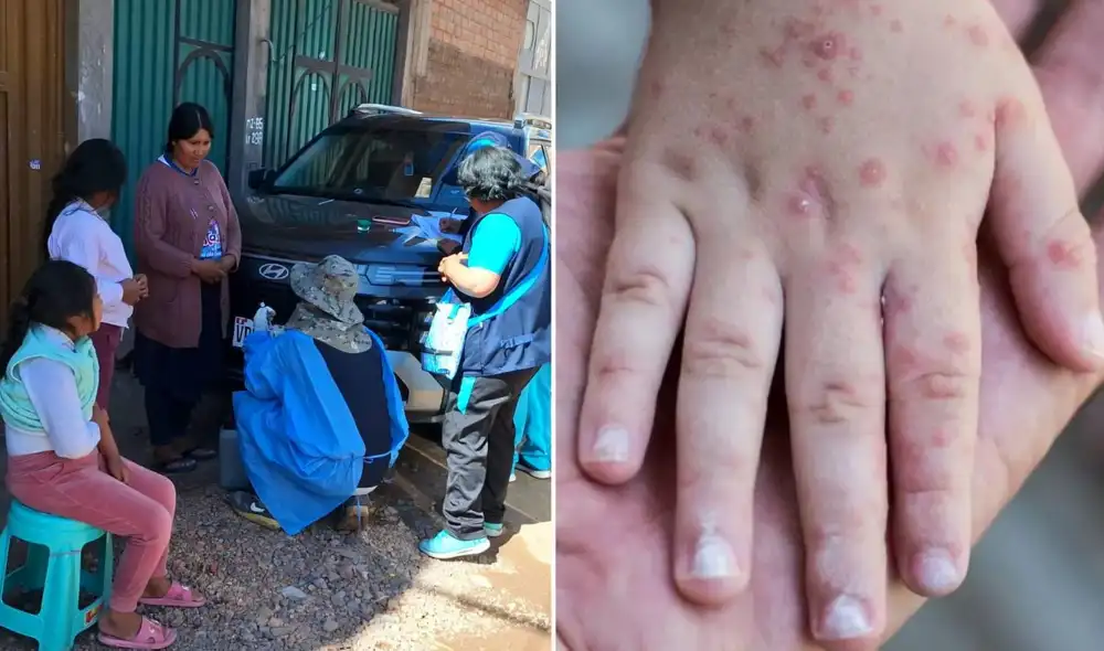 Puno enfrenta una alerta sanitaria debido al incremento de casos de sarampión, que pasaron de 2 a 8 en tres días. El Ministerio de Salud implementa brigadas de vacunación para frenar el brote.