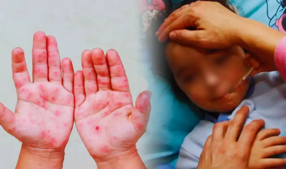 El virus “mano, pie y boca” afectaría principalmente a niños de entre 0 a 5 años.