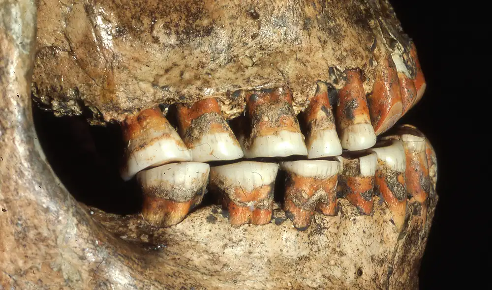 Un diente demuestra que los humanos prehistóricos fueron capaces de tratar las caries hace 59.000 años. Foto: Erik Trinkaus, Universidad de Washington en San Luis Un diente demuestra que los humanos prehistóricos fueron capaces de tratar las caries hace 59.000 años. Foto: Erik Trinkaus, Universidad de Washington en San Luis