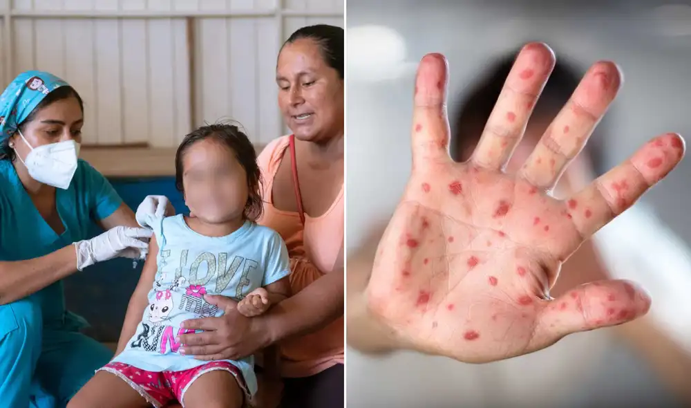 Perú se encuentra en emergencia sanitaria tras incremento de casos de sarampión.