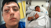 Joven peruano en España casi pierde un ojo tras agresión xenófoba en Madrid: "Nunca me pasó algo como esto"