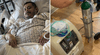 Inmigrante mexicano pierde la mitad de su pulmón por problemas de salud tras ser detenido por ICE en Estados Unidos