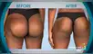 Mujer gastó 4 mil dólares por implantes de glúteos, pero el resultado fue desastroso [FOTOS]