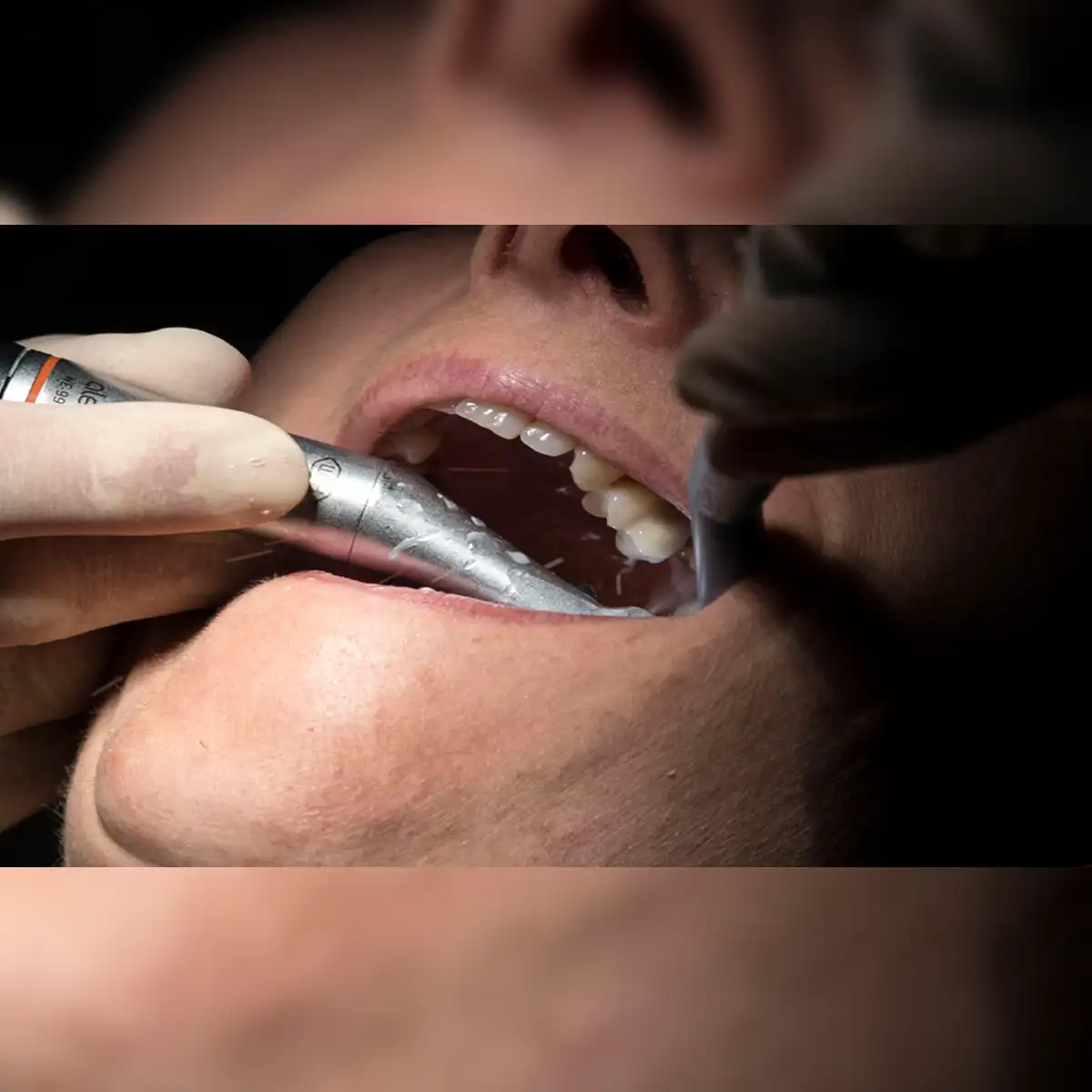 Soñar con la caída de dientes