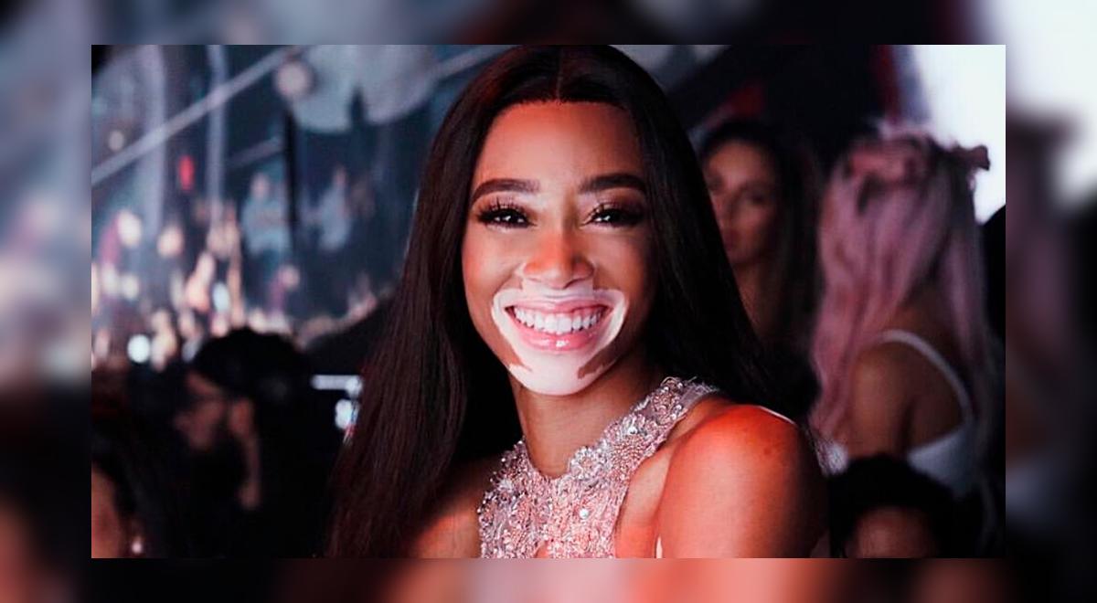 Instagram: Modelo con vitíligo fue elegida para el Victoria’s Secret ...