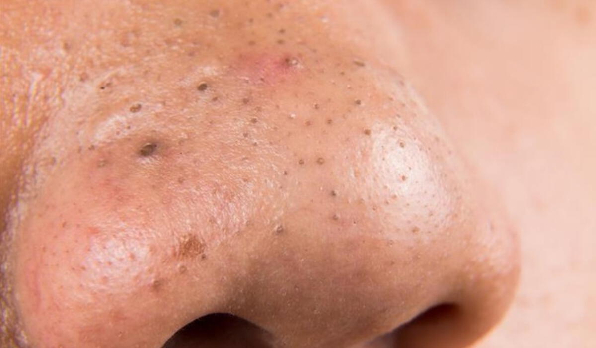 Cómo eliminar los puntos negros de la nariz de forma fácil, rápida y  económica | salud | piel | rostro | acné | mascarillas | rddr | Salud | La  República