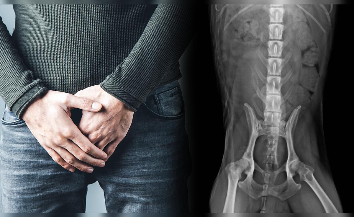 ¿Por qué los hombres son más vulnerables al cáncer que las mujeres ...