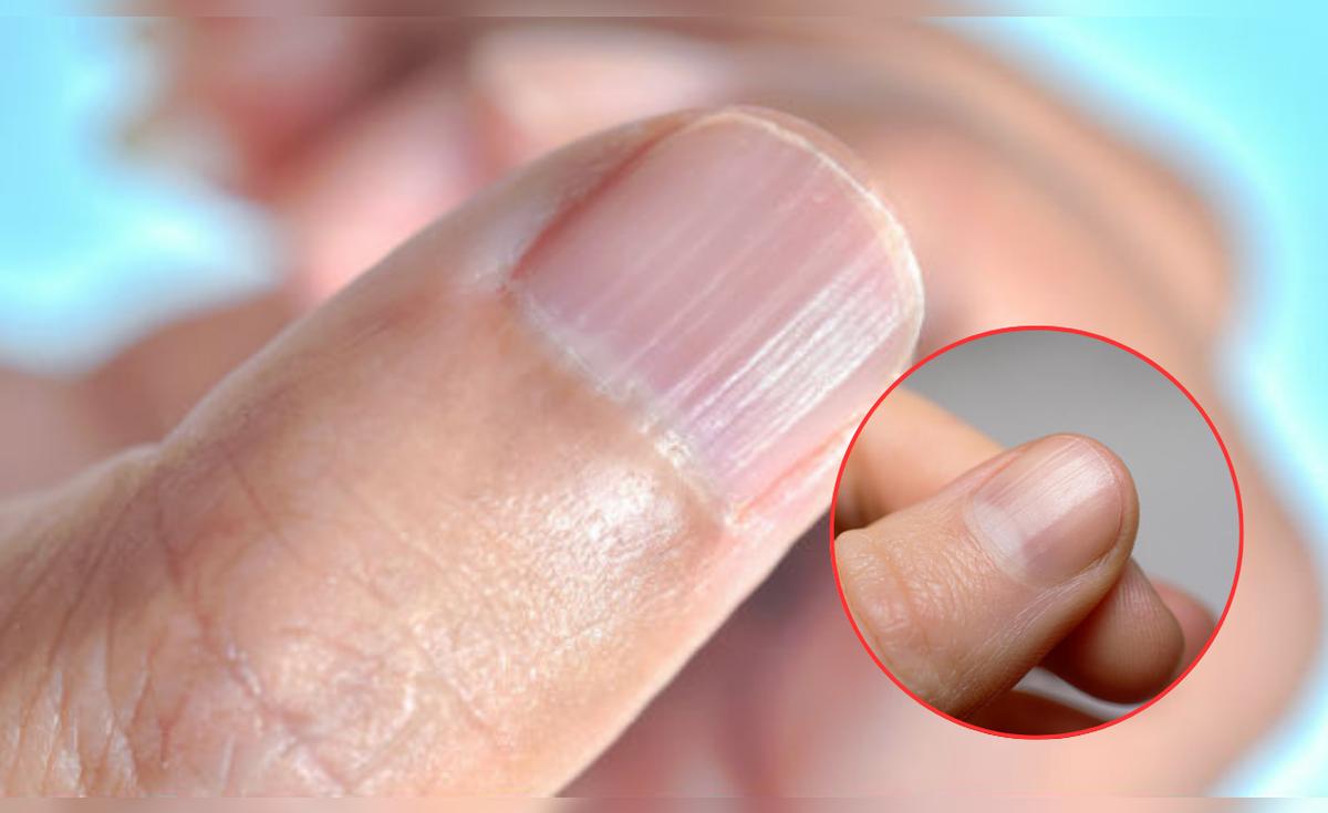qu-significa-tener-las-u-as-con-rayas-esto-podr-a-decir-de-tu-salud