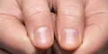 ¿Tus uñas tienen rayas? Descubre su significado y qué puedes hacer al respecto