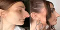 Joven en Estados Unidos ahorró más de 10 años para una rinoplastia que le cambió la vida: "Me llamaban bruja"