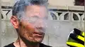 YouTube viral: se arrojó nitrógeno líquido en la cara y ahora luce así [VIDEO]