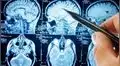 Algunos pacientes con coronavirus mostraron signos de lesiones cerebrales 