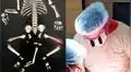 Médicos salvan la vida de un bebé que nació con tres piernas, dos genitales y sin ano [FOTOS]